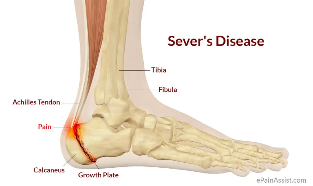 Image of foot with sever disease | Featured image for Traction Apophysitis blog.
