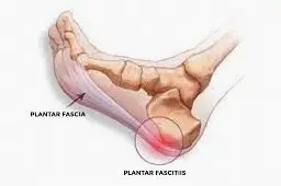 The Ultimate Plantar Fasciitis Treatment Guide