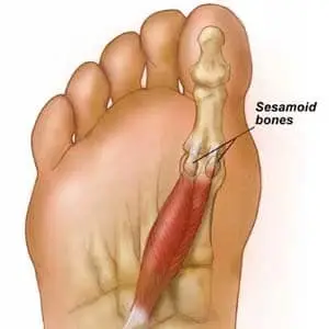 Sesamoiditis diagram
